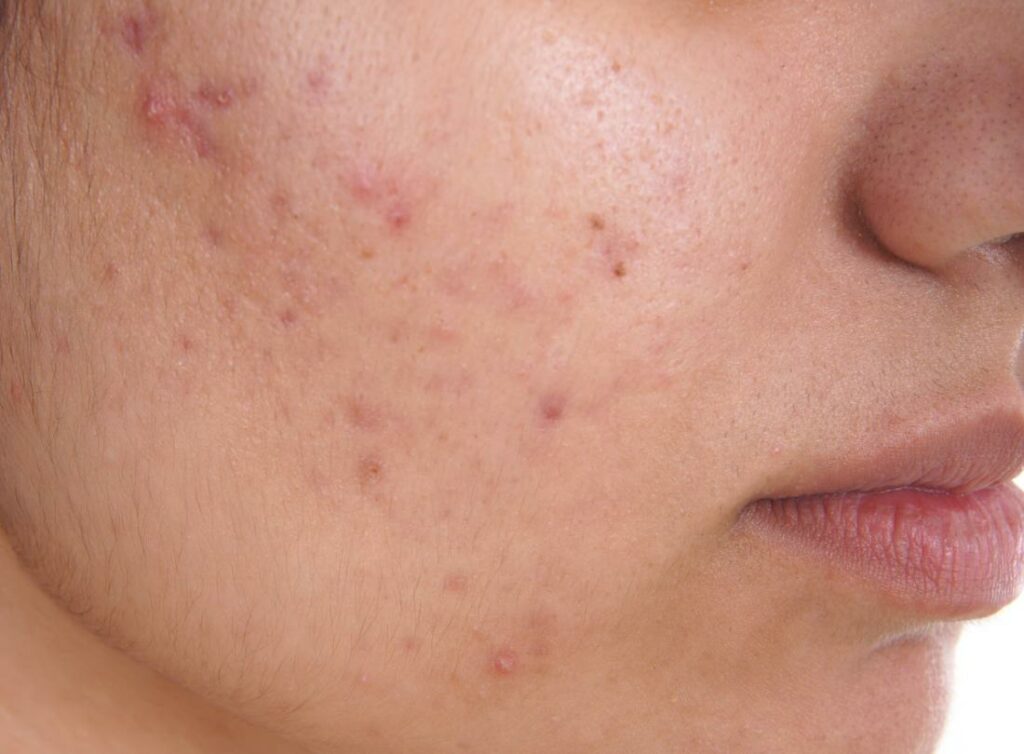 strategies-that-work-to-get-rid-of-body-acne-for-clearer-skin-lifestory